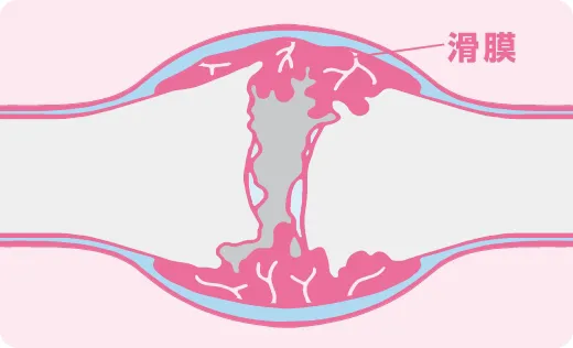 血友病性関節症