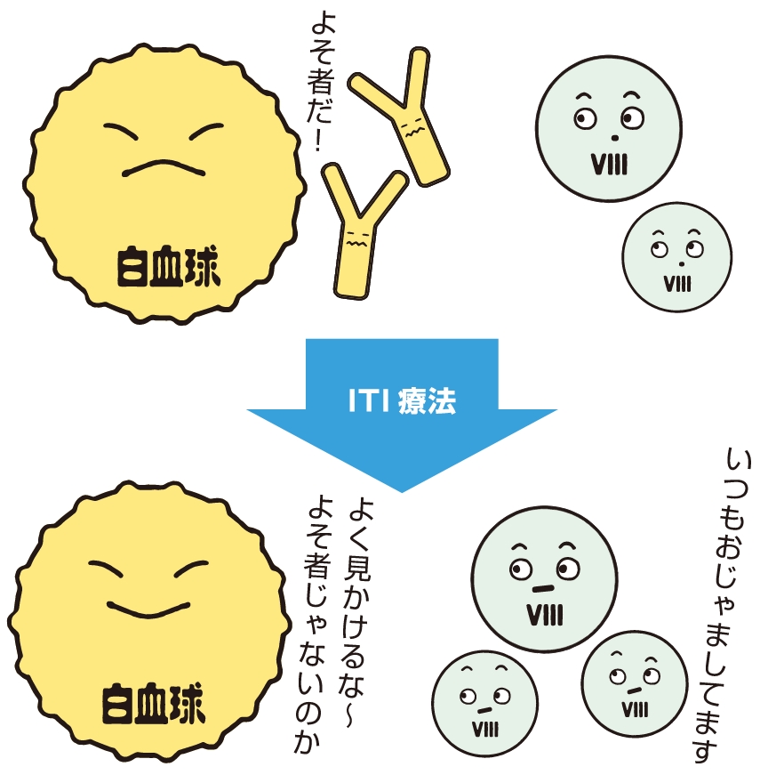 免疫寛容導入(ITI)療法