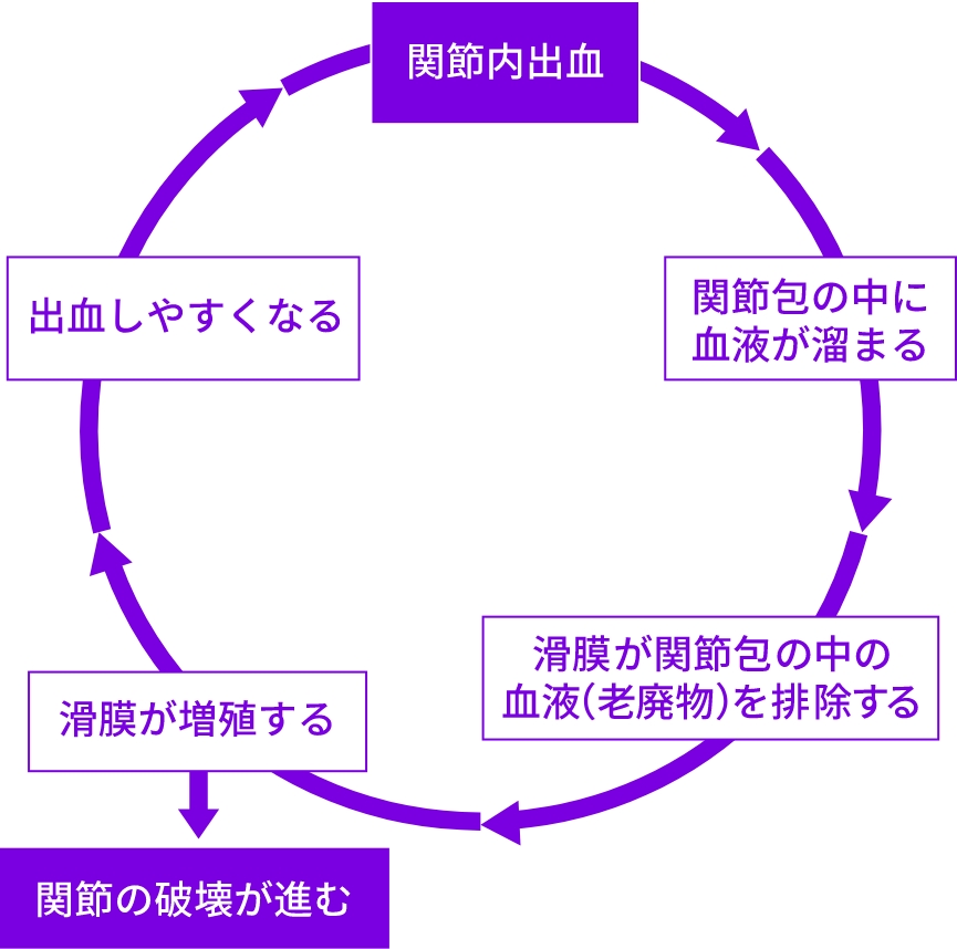 血友病性関節症とは（Hemophilic arthrosis）