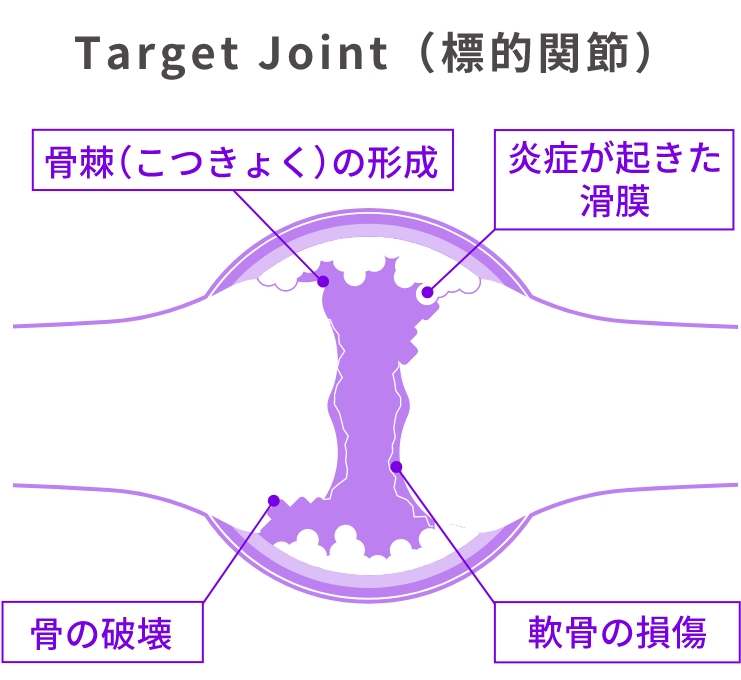 Target Joint（標的関節）