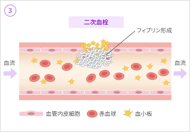 止血のしくみ - 二次止血（Hemostasis）